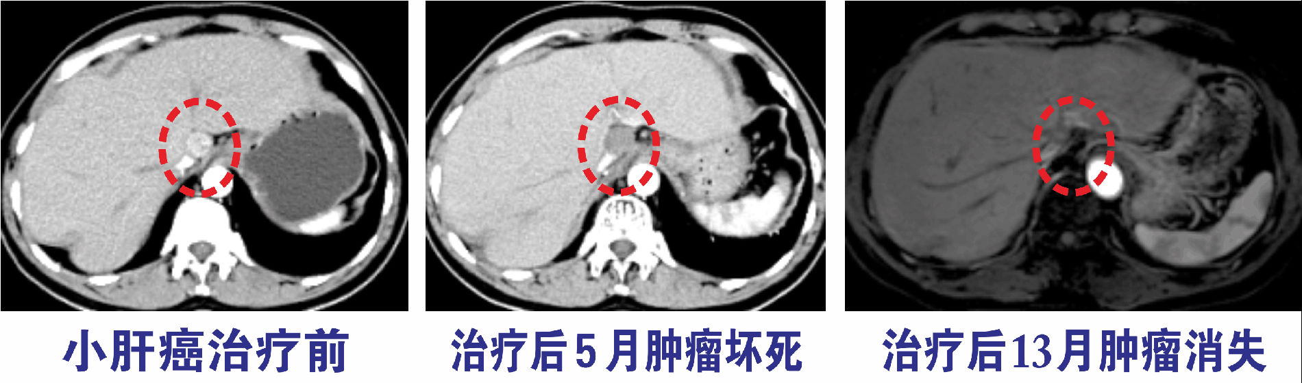 肝癌治疗前后影像对比