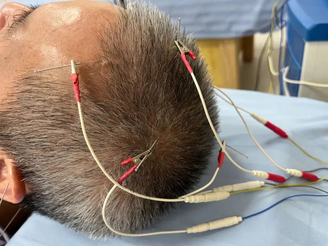 中医耳针治疗场景