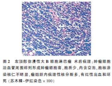 大B细胞淋巴瘤病理切片